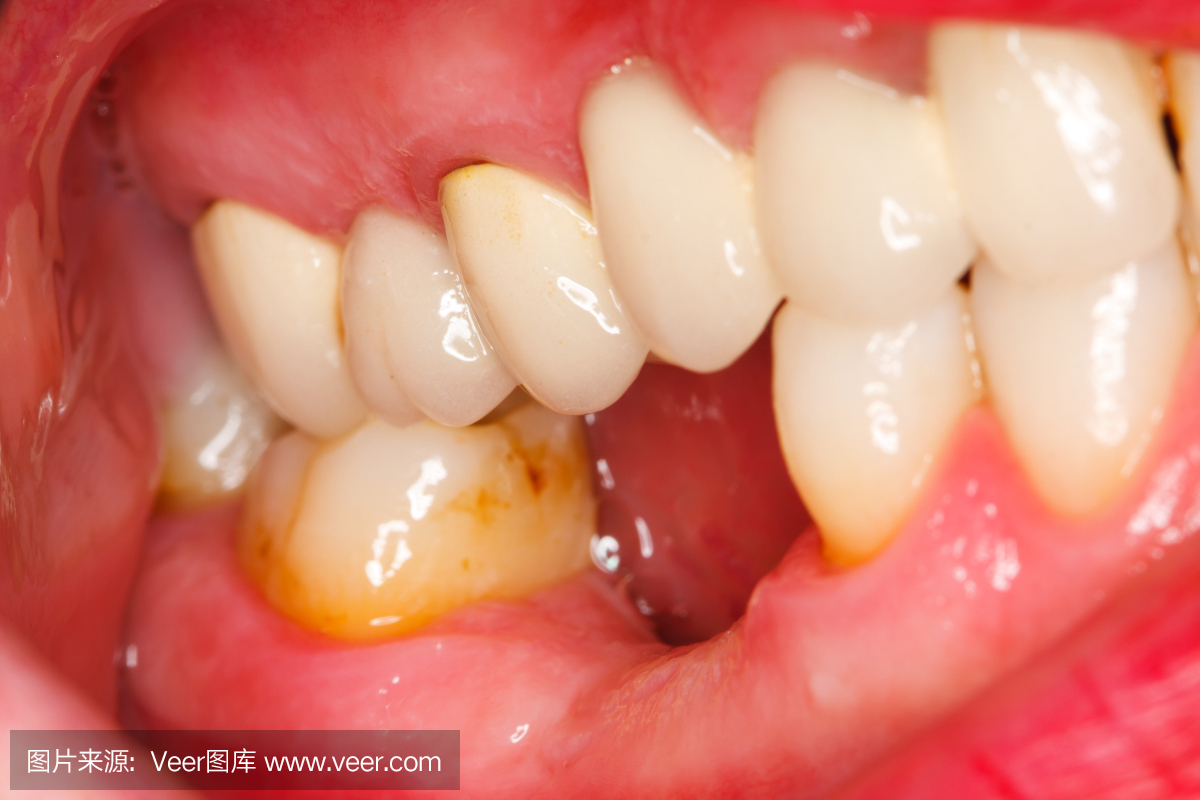 齿龈炎 牙痛 牙石 牙医 细菌 龋齿 健康保健 人的嘴