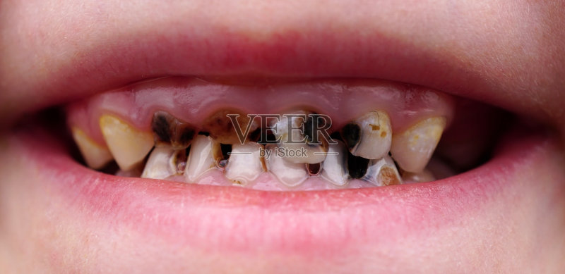 龋齿在孩子的牙齿上图片素材下载 - Veer图库