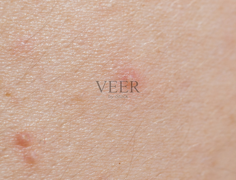 皮肤上的丘疹。关图片素材下载 - Veer图库